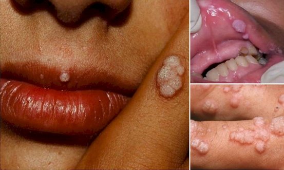 Maladies sexuellement transmissibles